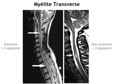 Sclérose en plaque irm médullaire